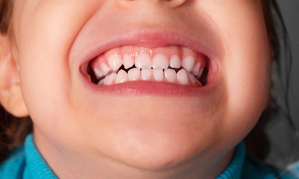 por qué los niños rechinan los dientes